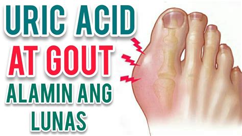Pamamaga Ng Paa: Sanhi, Gamot, at Home Remedy .